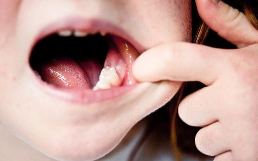 ​导致磨牙的因素 治疗磨牙要心理和药物治疗双管齐下