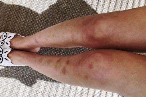 ​腿上有淤青是否真是被鬼掐的 有些淤青是血液病所致