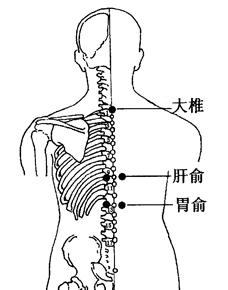 胃痉挛的拔罐疗法[图]